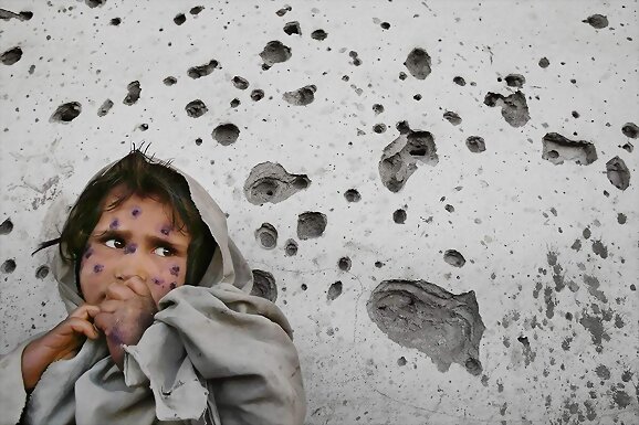 Leishmaniasis