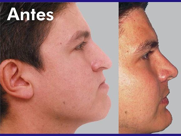 Pre y post Cirugía plástica