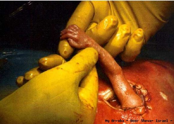 UN FETO TOMANDO LA MANO DEL DOCTOR DESDE EL UTERO