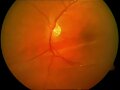 DESPRENDIMIENTO DE RETINA