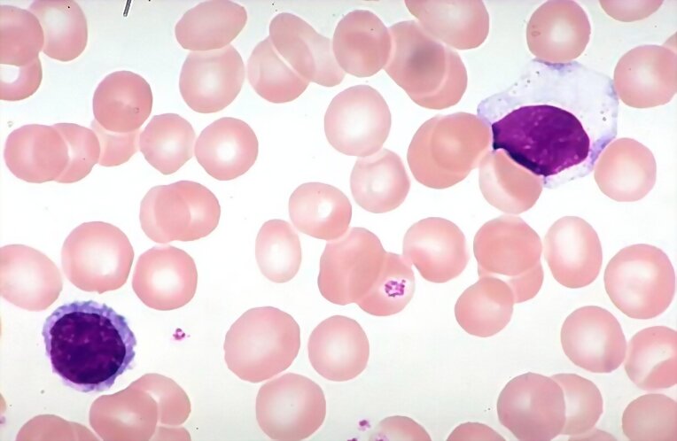 Científicos identifican gen de la leucemia