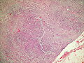 Lipoma condroide