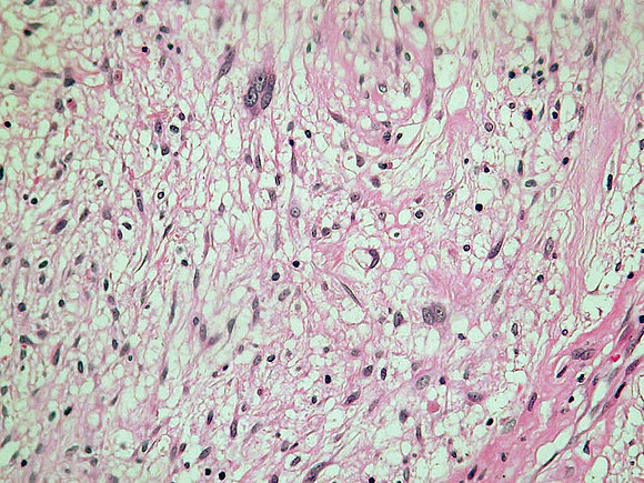 Sarcoma fibroblastico mixoinflamatorio