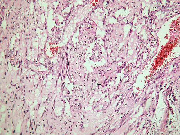 Miositis osificante