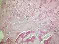 Miositis osificante