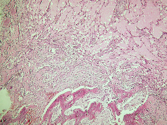 Miositis osificante