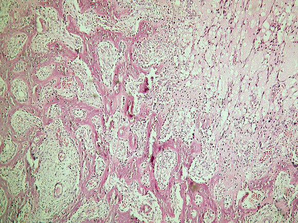 Miositis osificante