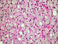Lipoma condroide