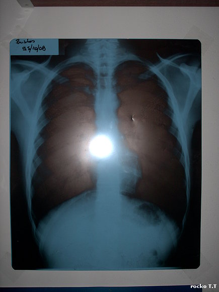 tengo corazon mira se ve ahi en la radiografia :/
