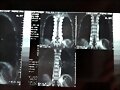 RX LUMBAR