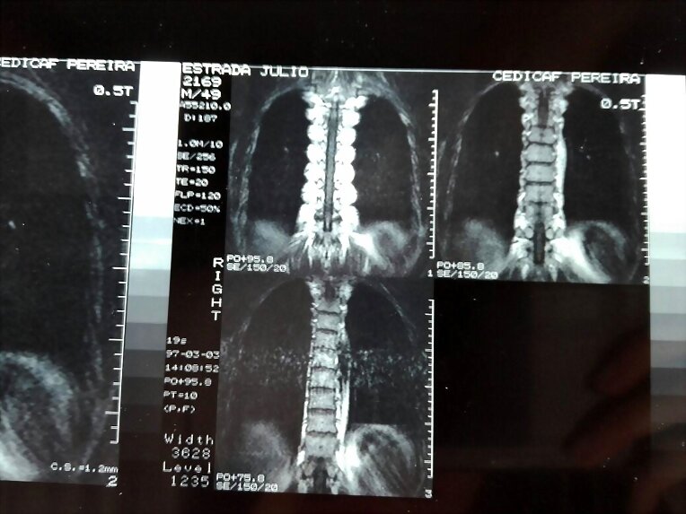 RX LUMBAR