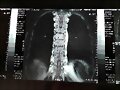 LUMBAR RX