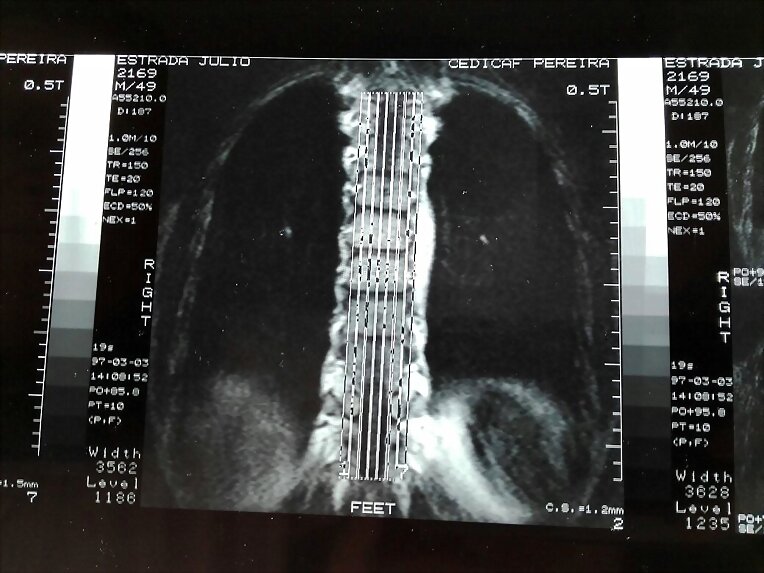 LUMBAR RX