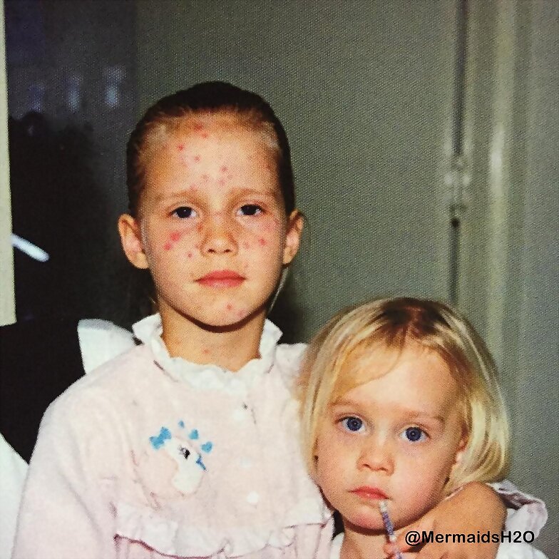 Claire Holt con la varicela de pequeña